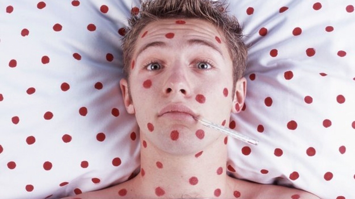 Количество заболевших корью опять начало рости. Умерло 14 человек