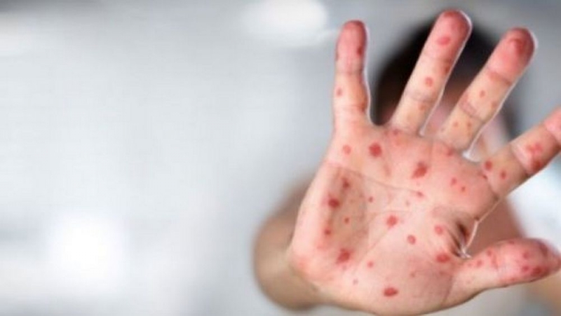 На Днепропетровщине заболеваемость корью возросла в 30 раз