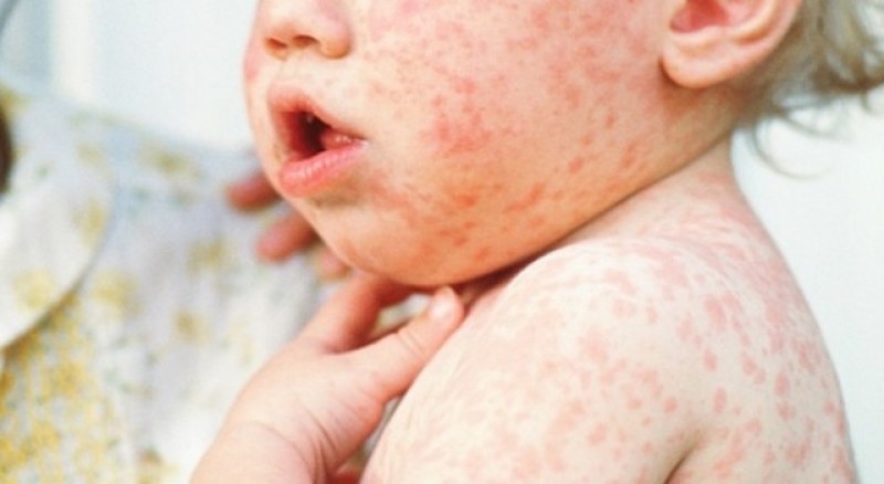 Главный педиатр Павлограда рассказала о ситуации с корью в городе