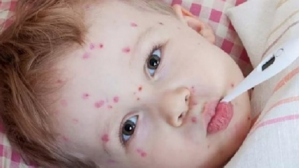 С начала года корью заболели более 5 тысяч человек, в Днепропетровской области 55 случаев