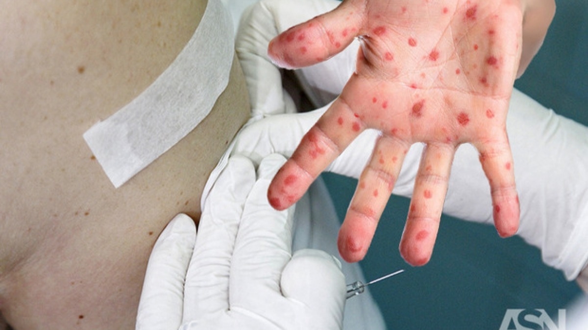 В Павлоградской школе зафиксирован только один случай заболевания корью