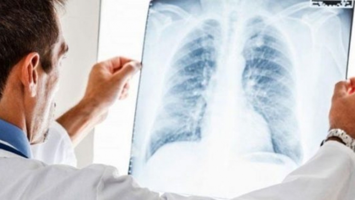 В Украине уменьшилось число больных туберкулезом – МОЗ