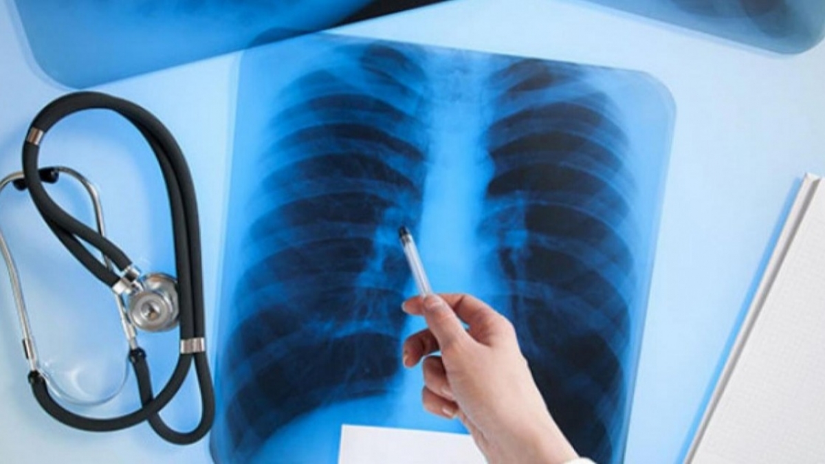 Врачи напомнили как выявить туберкулез на ранней стадии